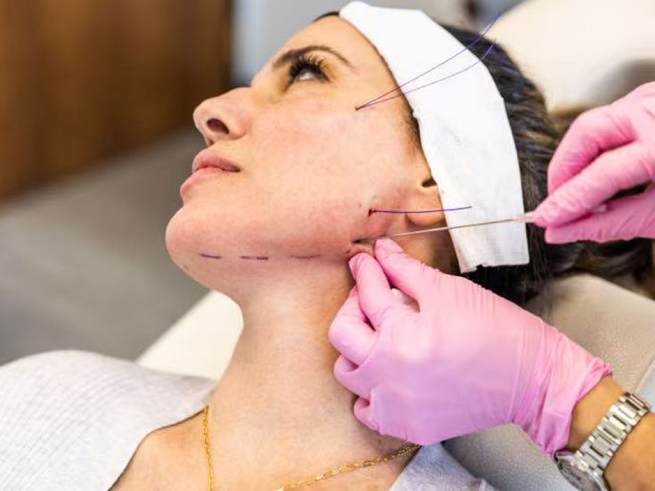 Review A-Z Quy Trình Căng Chỉ Da Mặt