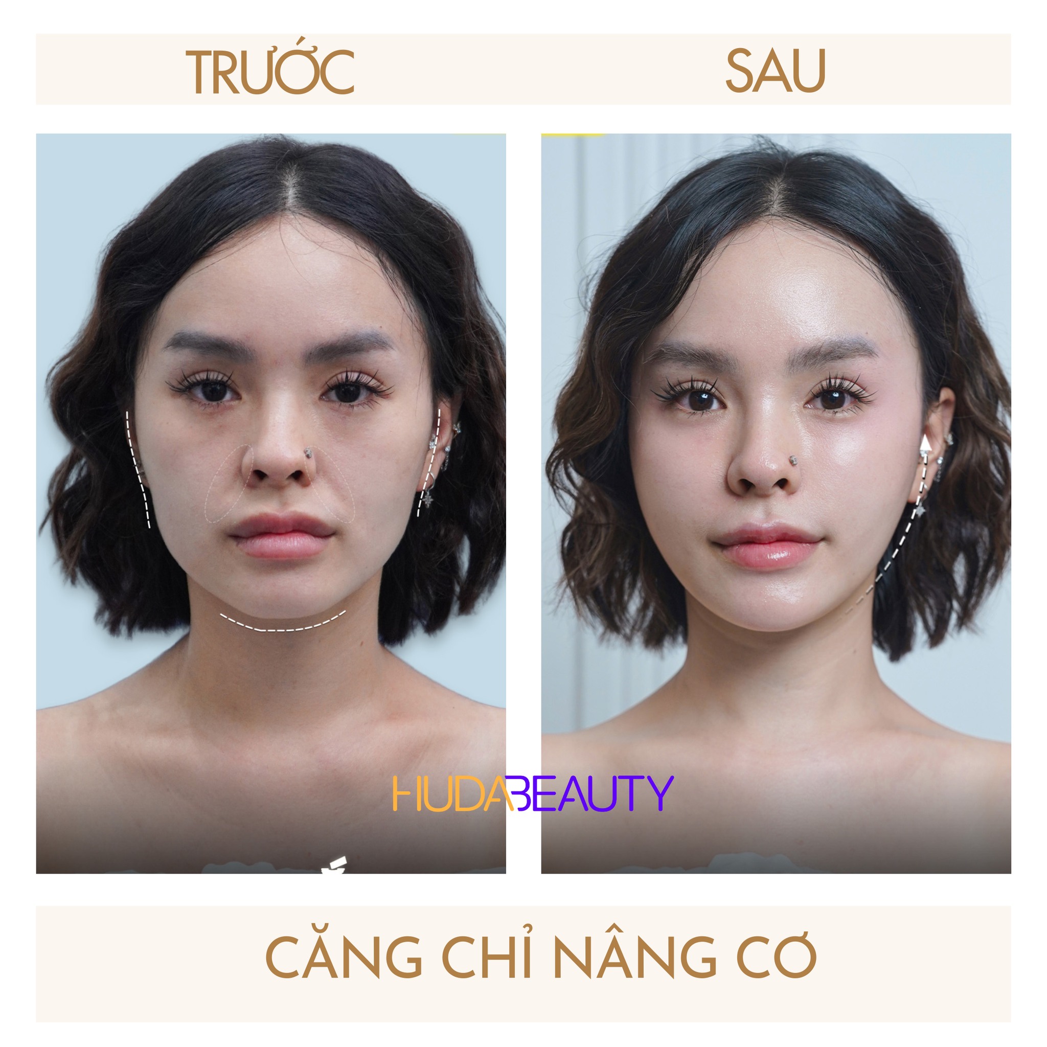 So Sánh Căng Chỉ Collagen Và Căng Chỉ Vàng