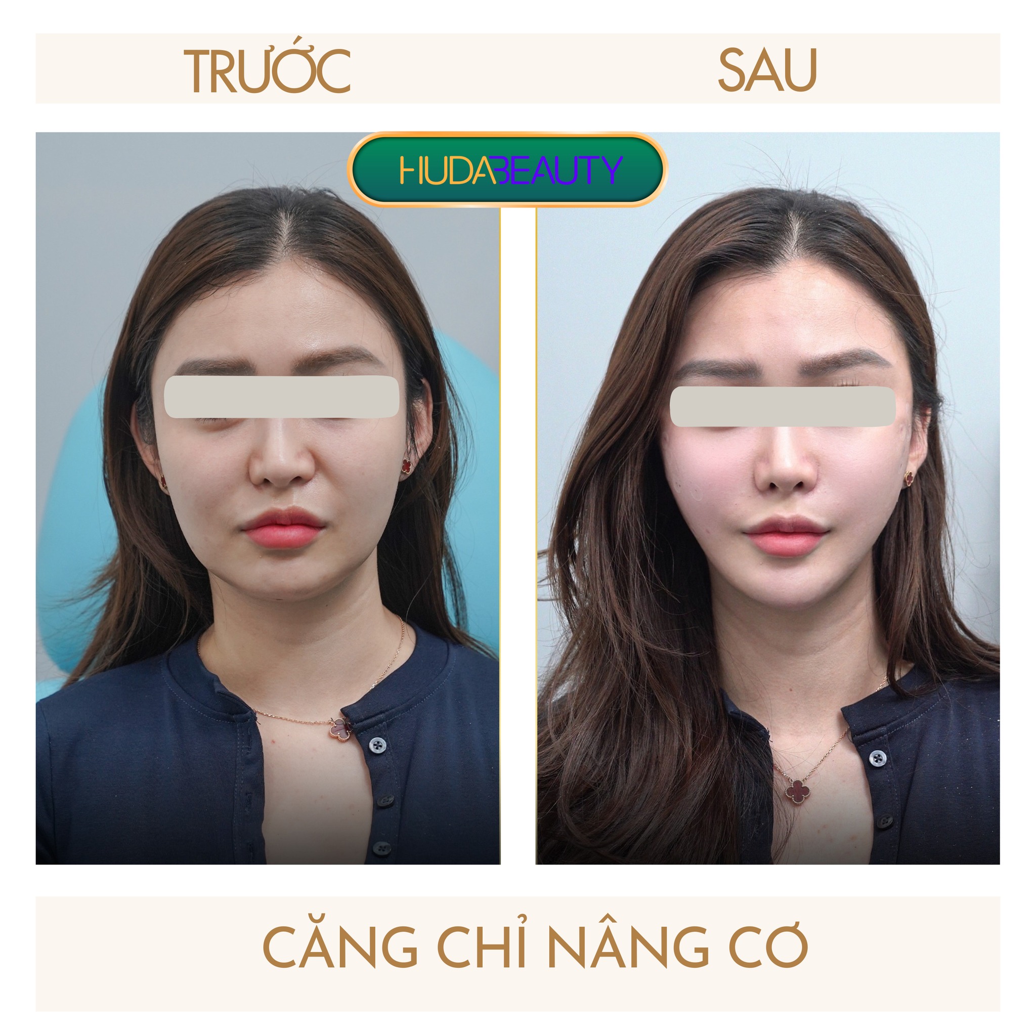 So Sánh Căng Chỉ Collagen Và Căng Chỉ Vàng