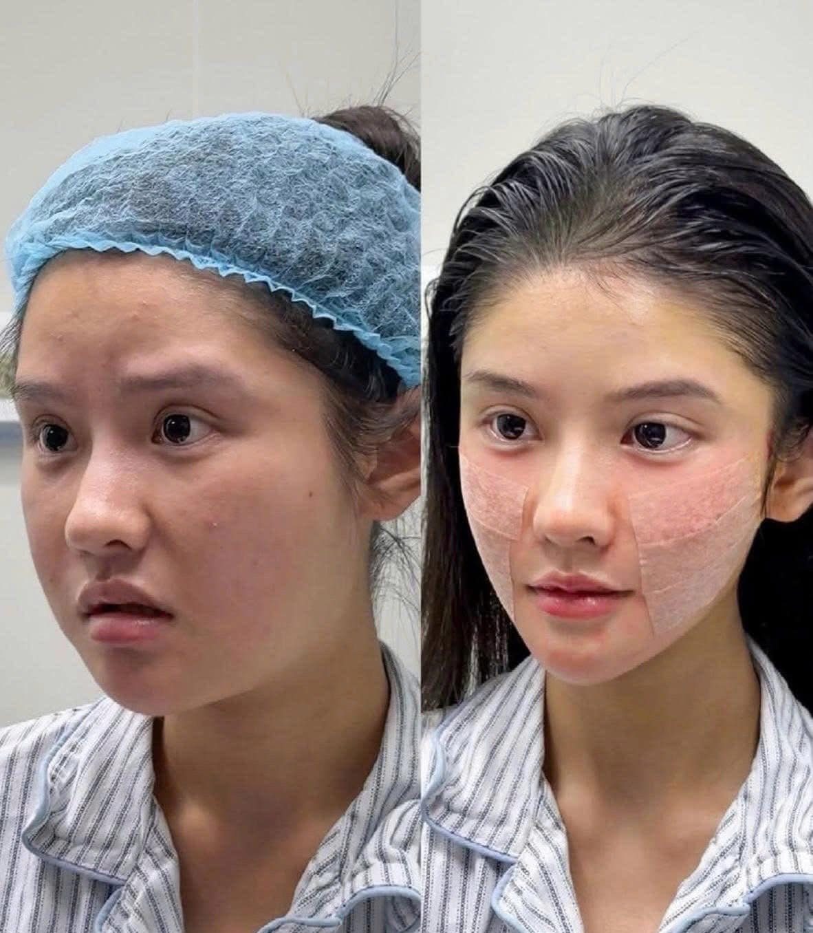 Trẻ Hóa Da Không Dao Kéo – Căng Chỉ Là Giải Pháp Bạn Nên Biết Ngay