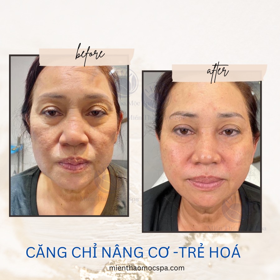 Căng Chỉ Có Giúp Tăng Sinh Collagen Không? Góc Nhìn Y Khoa
