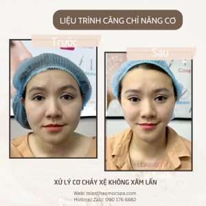 Căng Chỉ Có Giúp Tăng Sinh Collagen Không? Góc Nhìn Y Khoa