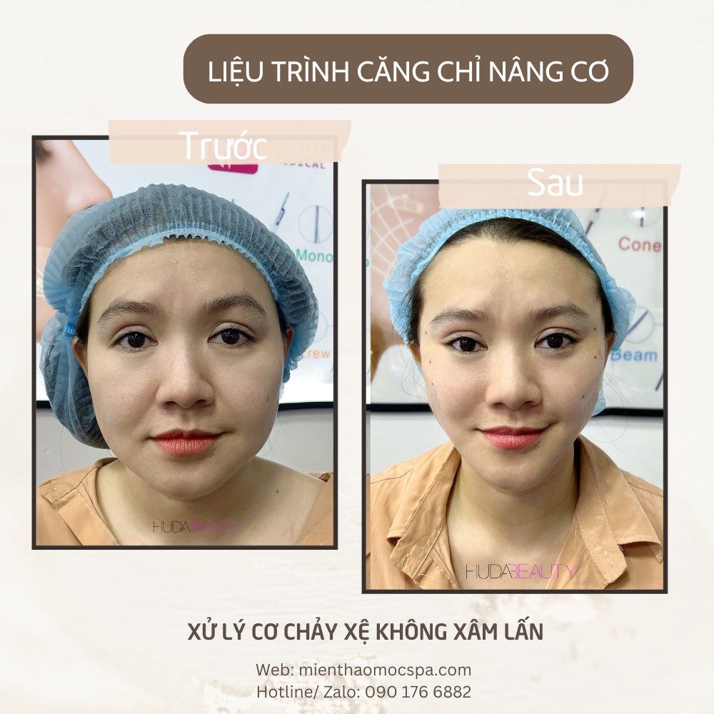 Căng Chỉ Có Giúp Tăng Sinh Collagen Không? Góc Nhìn Y Khoa