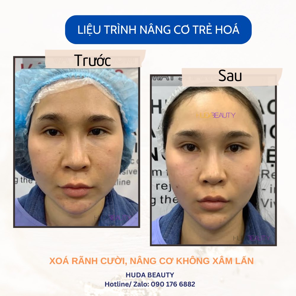 Căng Chỉ Da Mặt Có Duy Trì Vĩnh Viễn Không?
