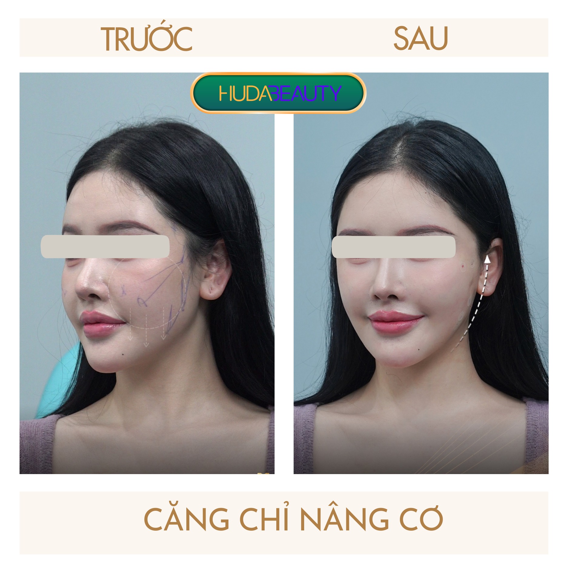 Căng Chỉ Da Mặt Có Duy Trì Vĩnh Viễn Không?