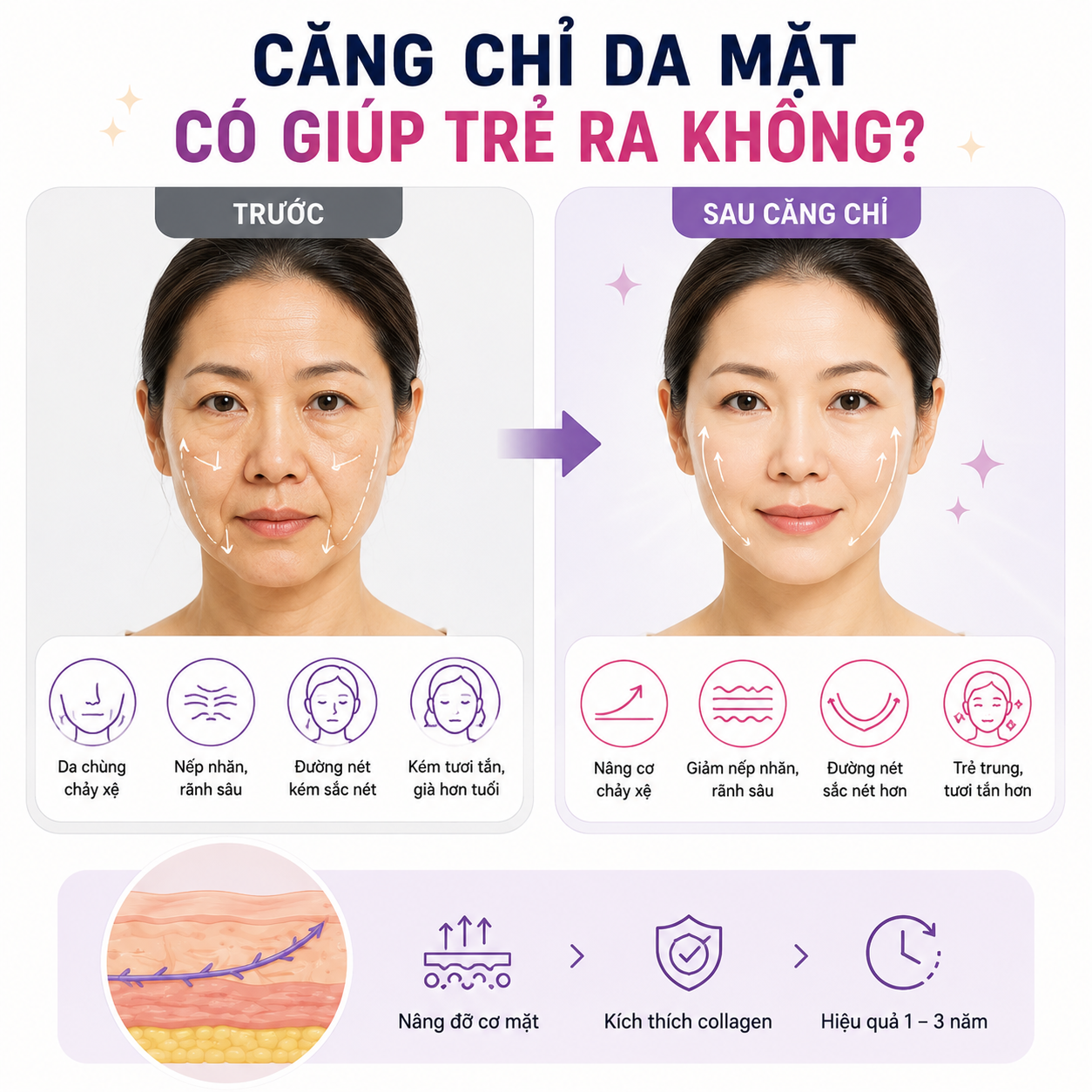 Căng Chỉ Da Mặt Có Giúp Trẻ Ra Không
