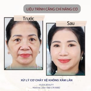 Căng Chỉ Da Mặt Có Khiến Mặt Bị Đơ Cứng Không?