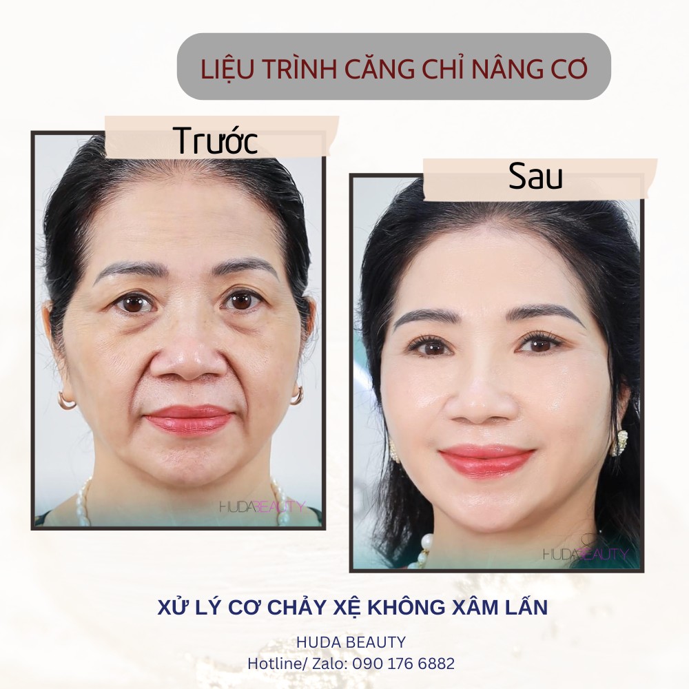 Căng Chỉ Da Mặt Có Khiến Mặt Bị Đơ Cứng Không?