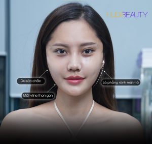 Căng Chỉ Má Chảy Xệ Có Hiệu Quả Không