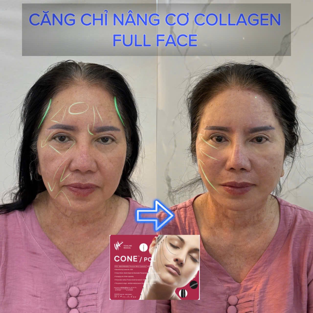 Căng Chỉ Má Chảy Xệ Có Hiệu Quả Không