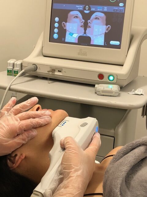 Căng chỉ hay Ultherapy tốt hơn