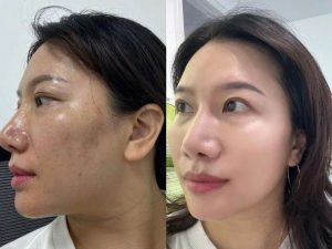 Căng chỉ hay tiêm BAP tốt hơn