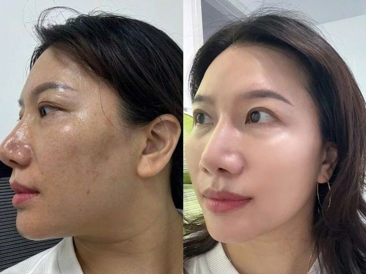 Căng chỉ hay tiêm BAP tốt hơn