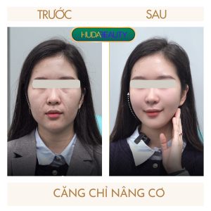 Hướng dẫn chăm sóc sau phẫu thuật căng da mặt bằng chỉ