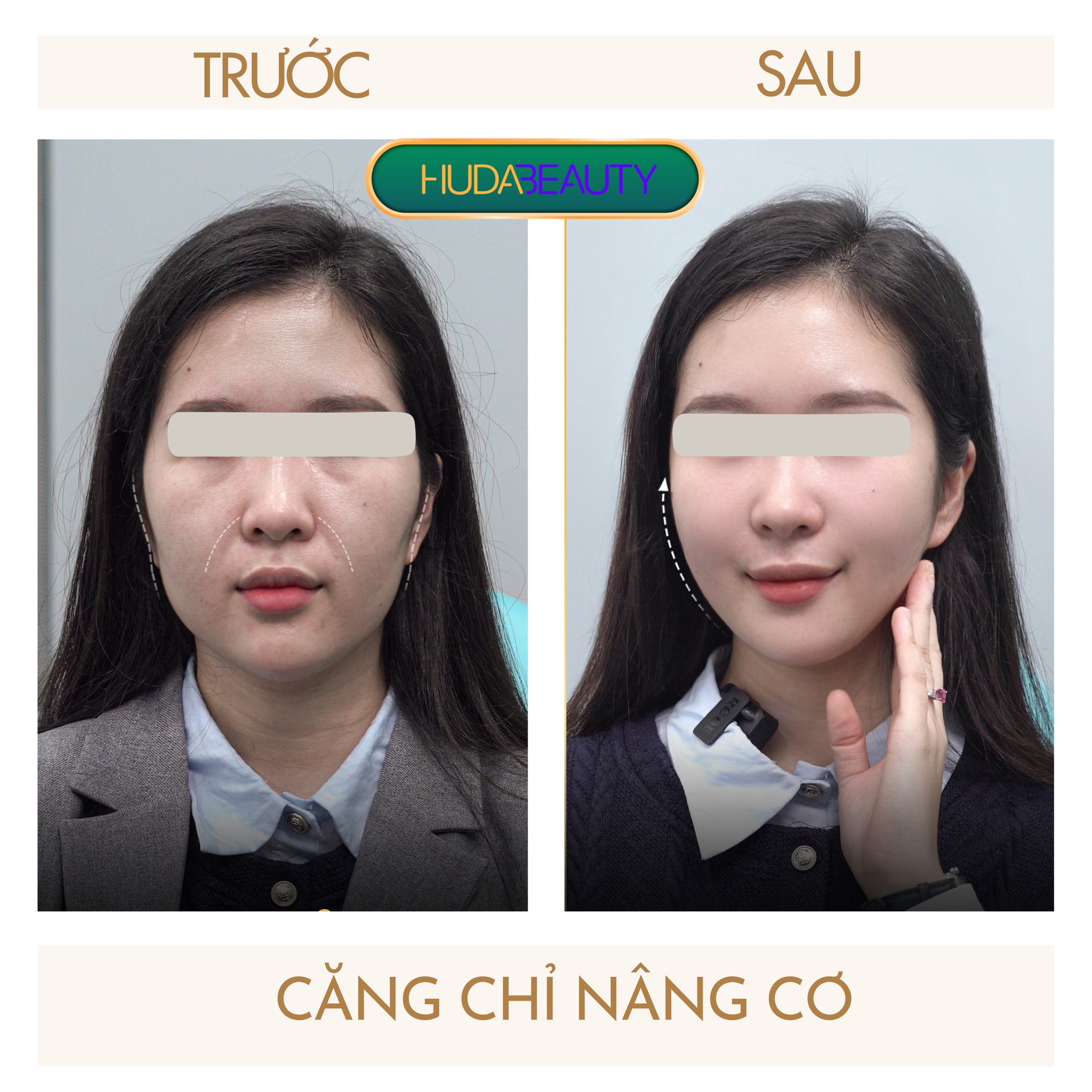 Hướng dẫn chăm sóc sau phẫu thuật căng da mặt bằng chỉ