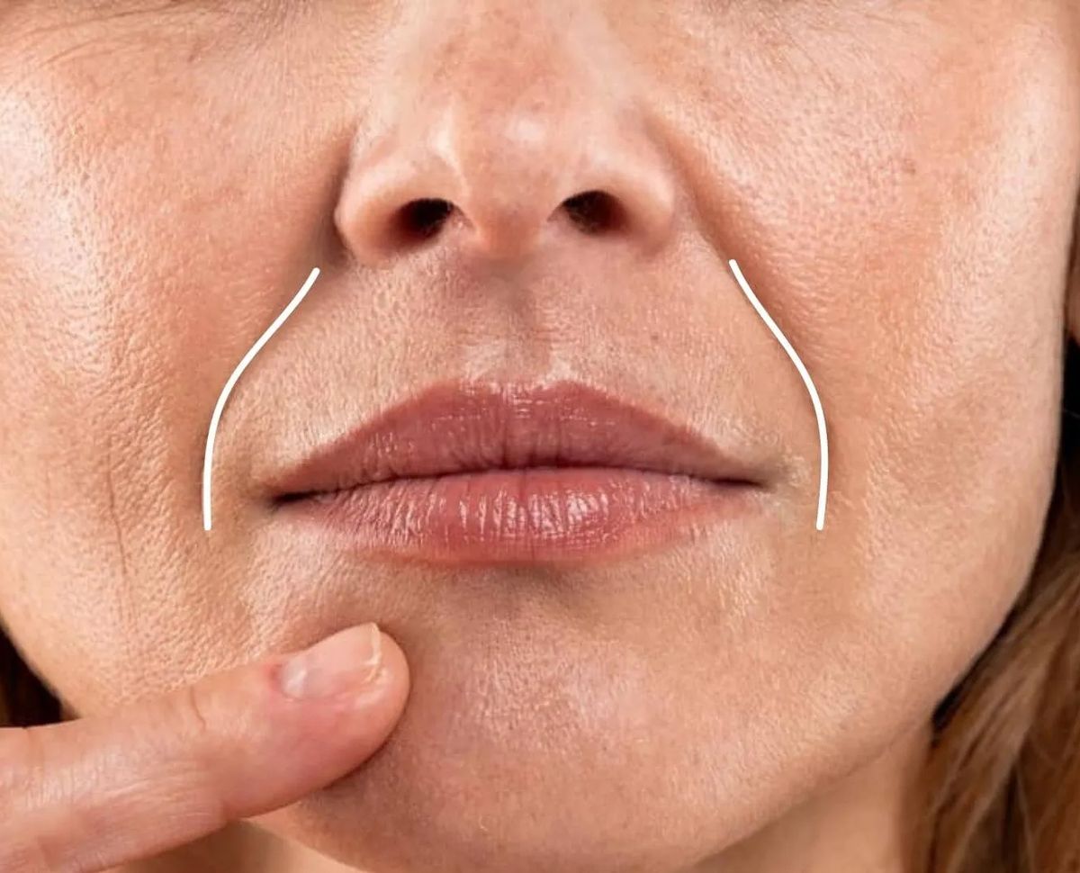 Rãnh Cười Sâu: Hiểu Rõ Nguyên Nhân Phẫu Thuật Học Và Cách Chữa Trị