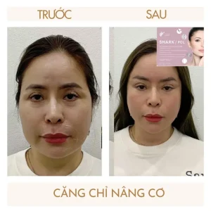 Vì Sao Có Người Căng Chỉ Đẹp Tự Nhiên, Có Người Không