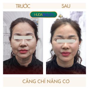 Căng Chỉ Có Bị Lộ Chỉ Không