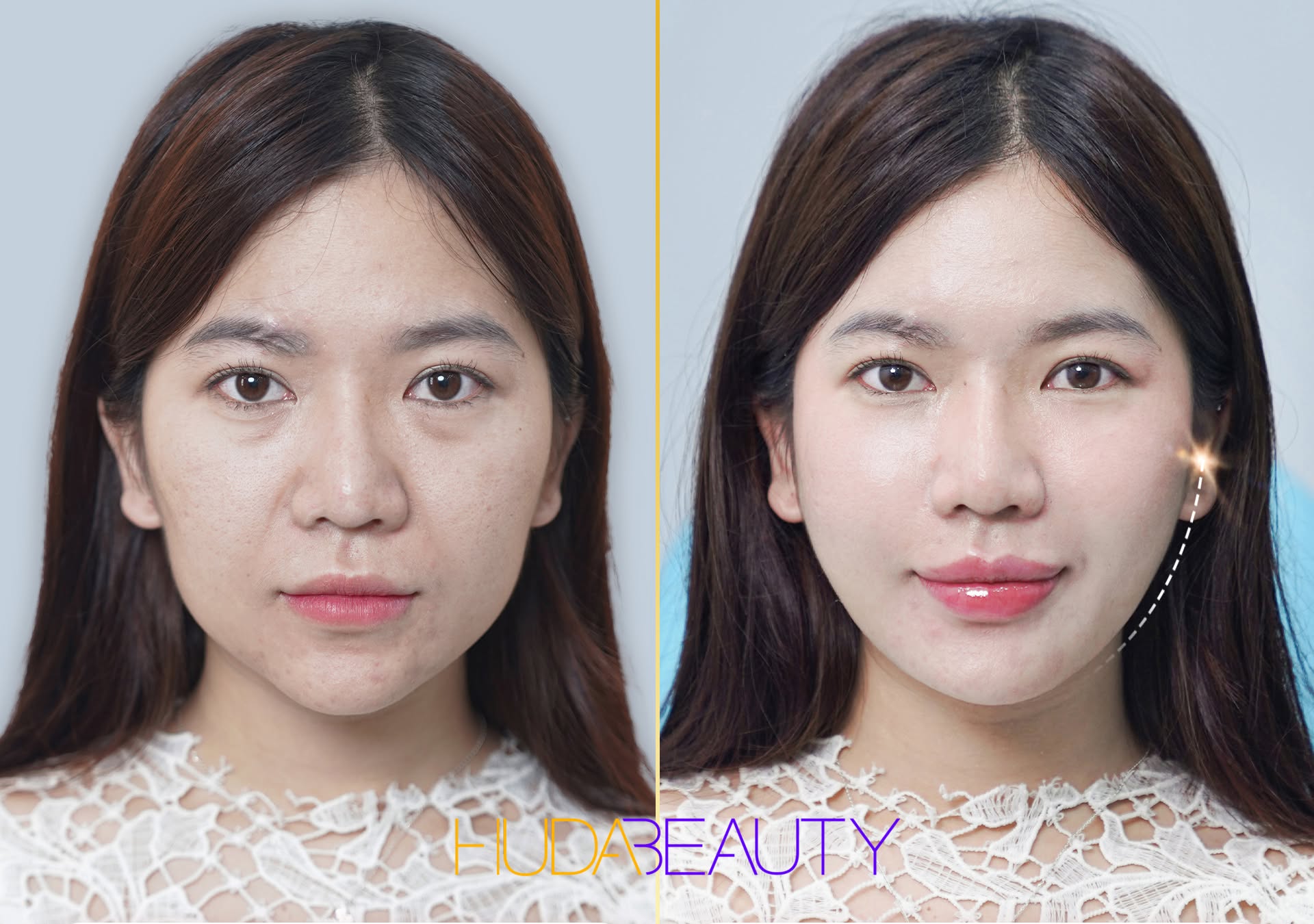 Căng Chỉ Giúp Cải Thiện Những Vấn Đề Gì Cho Làn Da Lão Hóa