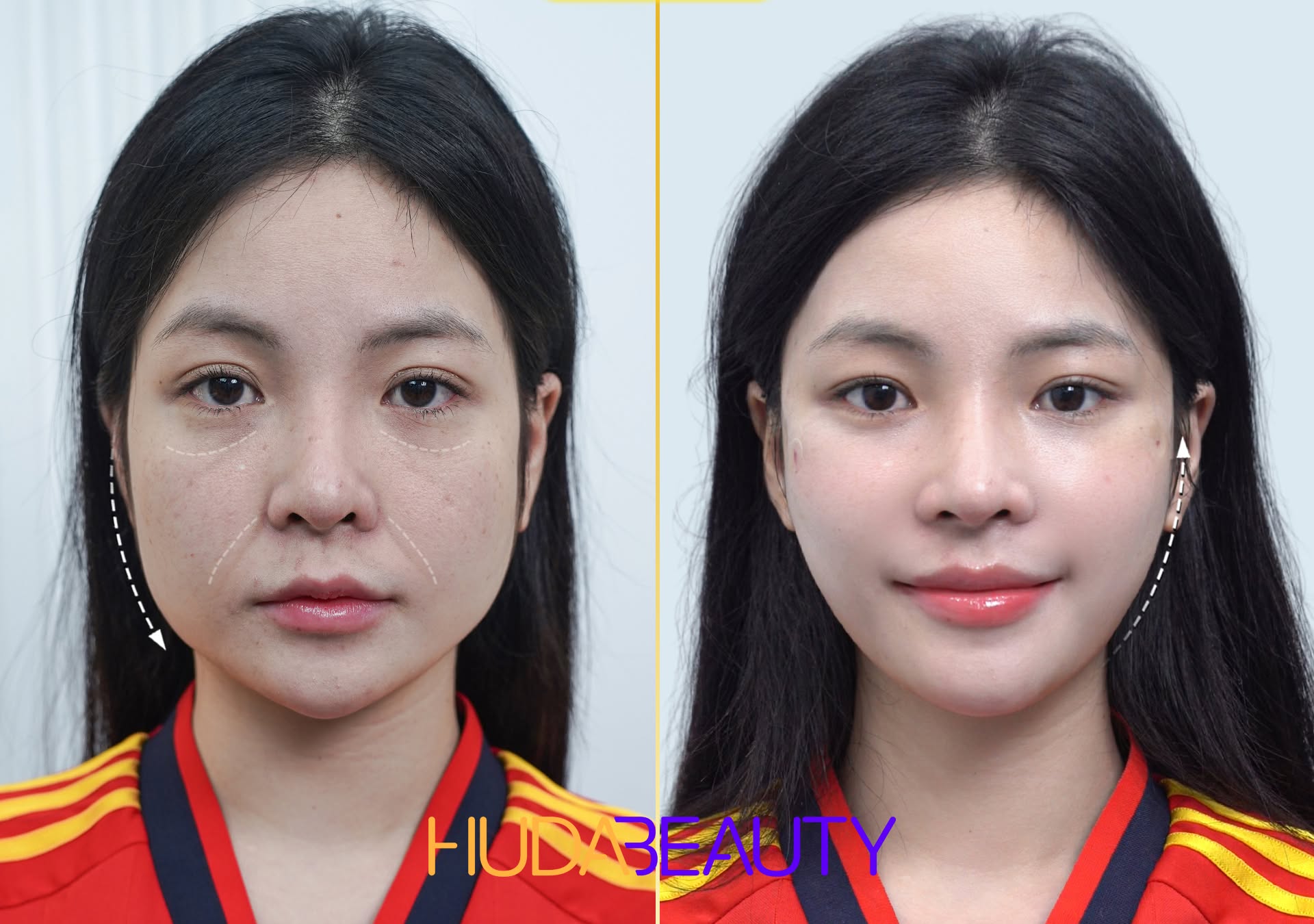 Căng Chỉ Giúp Cải Thiện Những Vấn Đề Gì Cho Làn Da Lão Hóa