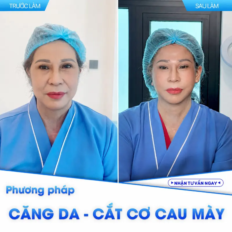 Căng Chỉ Và Căng Da Mặt Khác Nhau Như Thế Nào
