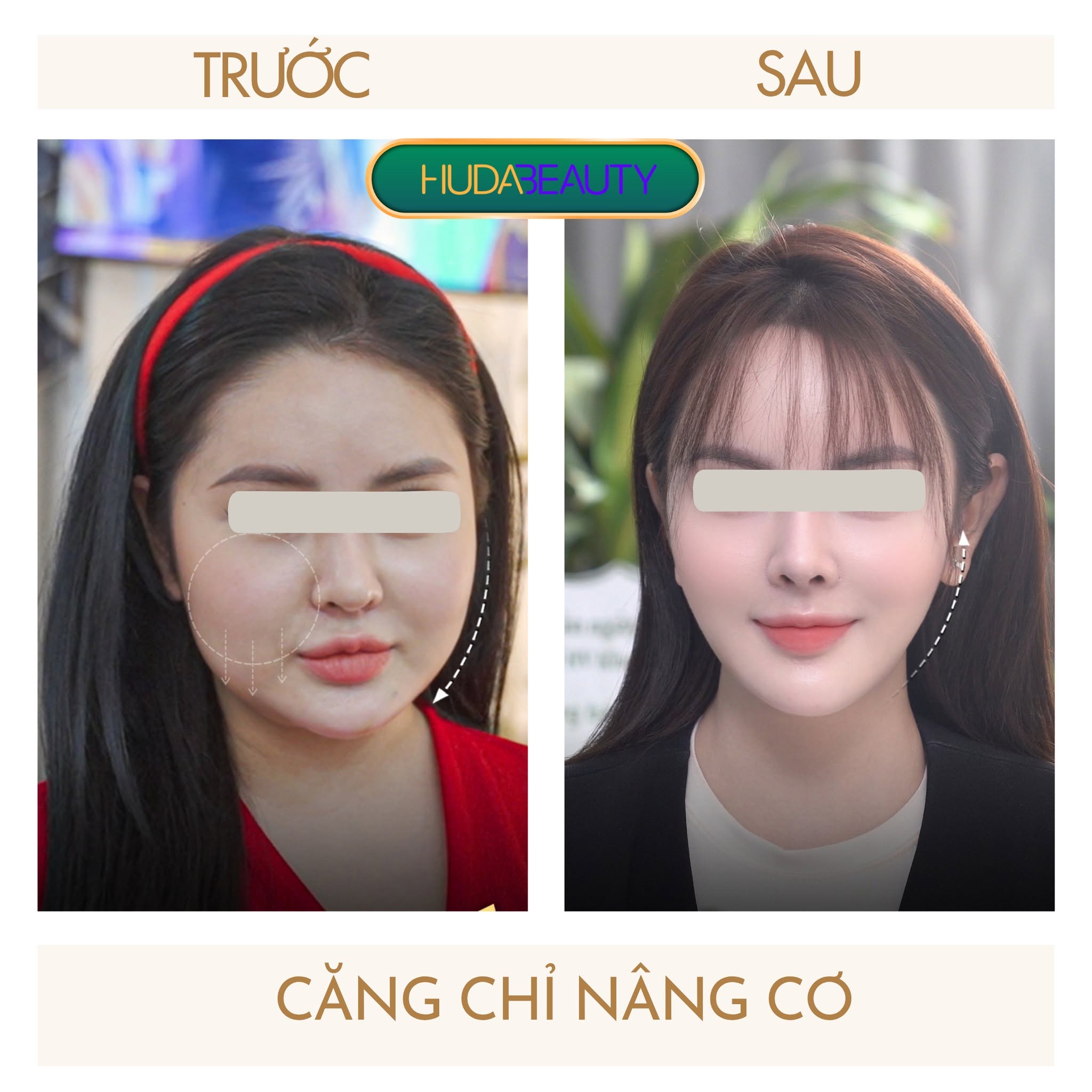 Căng chỉ giúp gương mặt thon gọn hơn không