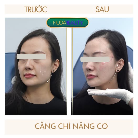 Cơ chế nâng cơ của chỉ sinh học hoạt động như thế nào