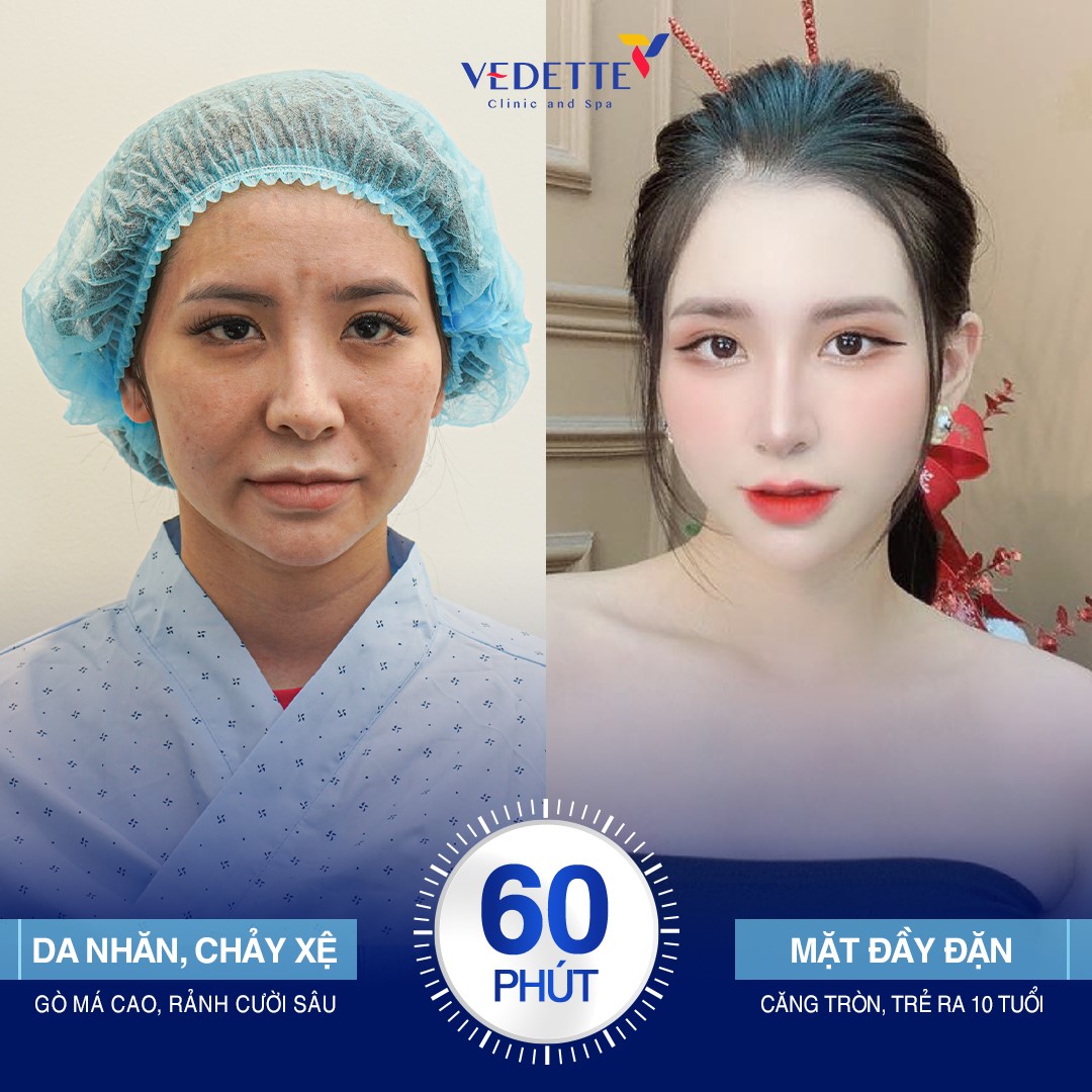 Mất Collagen Ảnh Hưởng Đến Khuôn Mặt Như Thế Nào