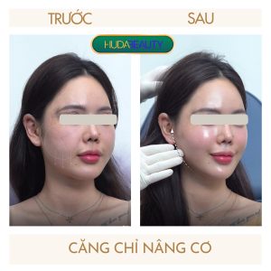 Review Căng Chỉ Sau 30 Ngày: Gương Mặt Thay Đổi Ra Sao