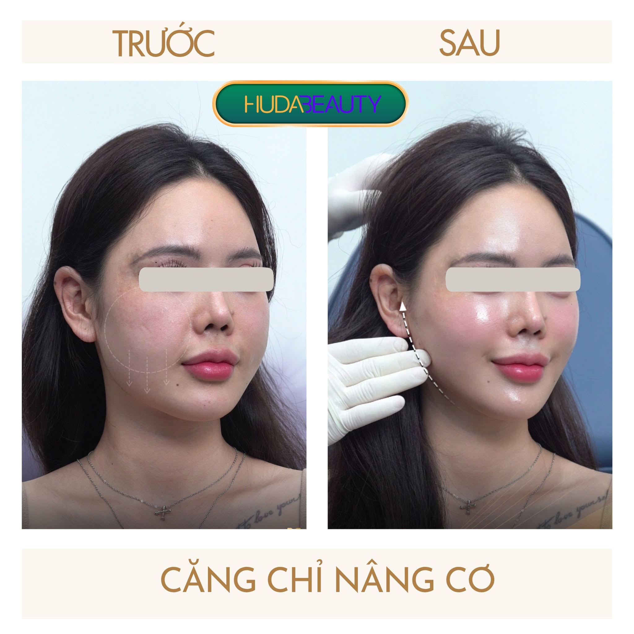Review Căng Chỉ Sau 30 Ngày: Gương Mặt Thay Đổi Ra Sao