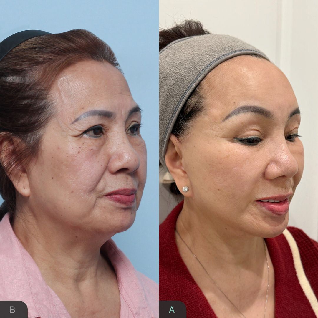Tiêm Filler Hay Căng Chỉ Tốt Hơn. Giải Đáp Từ Chuyên Gia Da Liễu